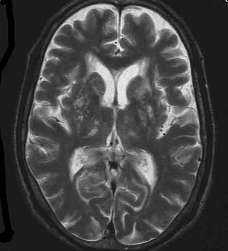 脳MRI画像